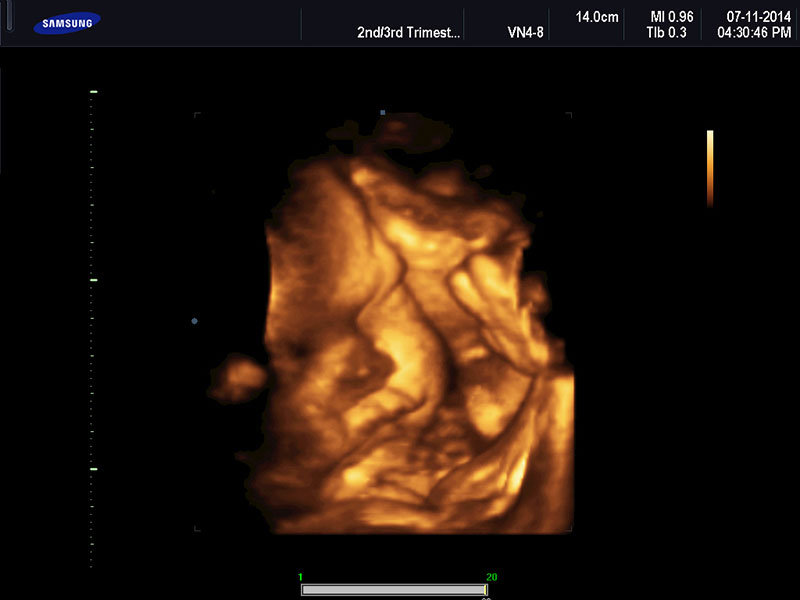 3D/4D ultrazvuk